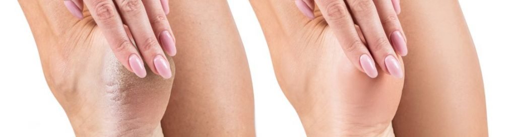 Ayush for cracked heels